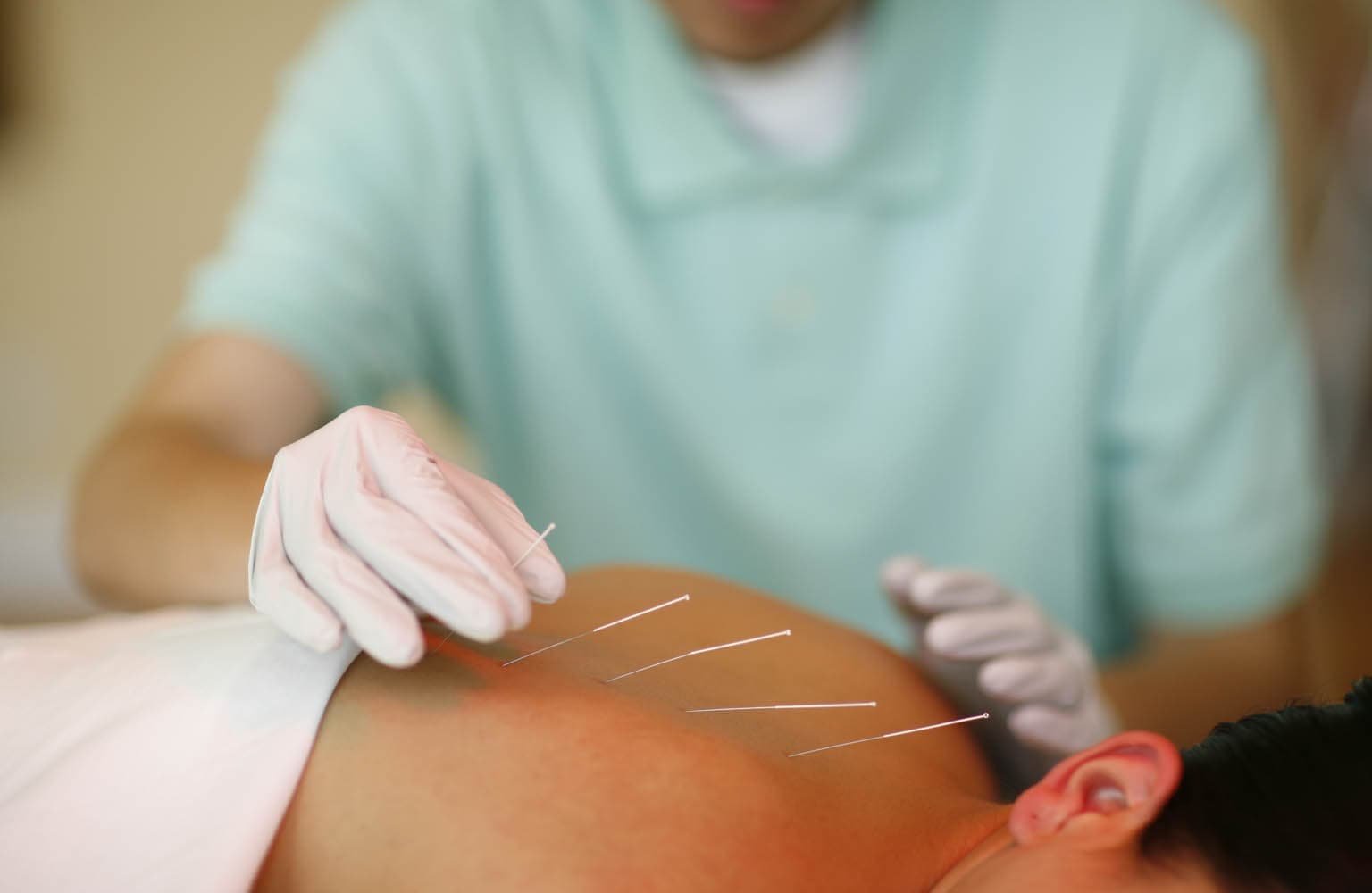 Acupuncture therapy session at Passages Malibu